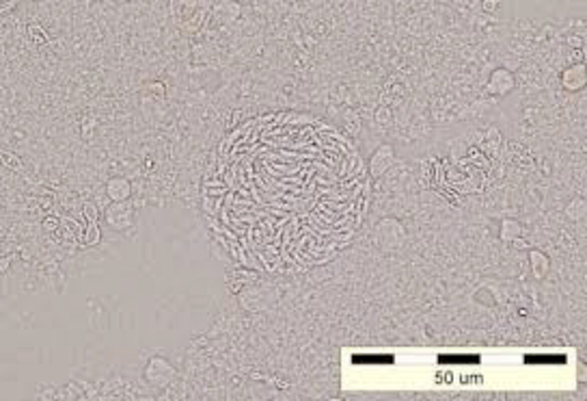 Brain abscess caused by Toxoplasma protozoan parasite